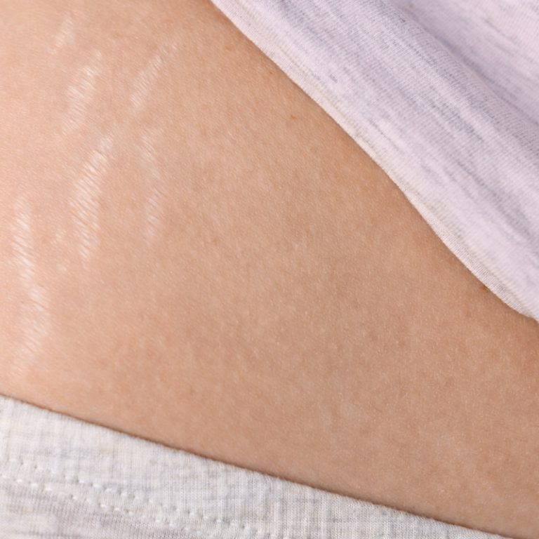 Female body with stretch marks on the abdomen after childbirth close-up. Changes in the skin, scars that differ in color.